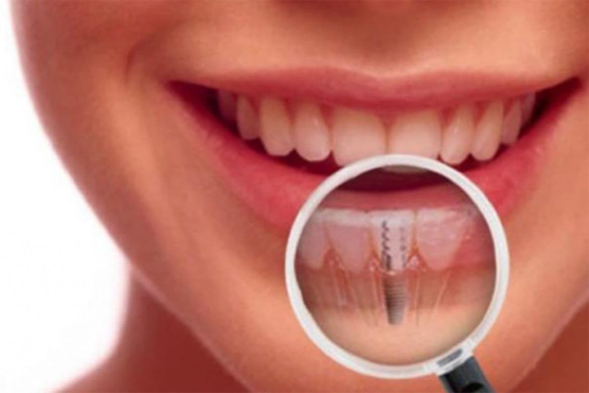 Are You a Candidate for Dental Implants?