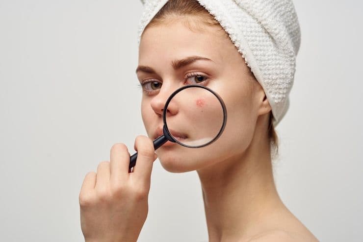 Can pimple treatment prevent future breakouts?